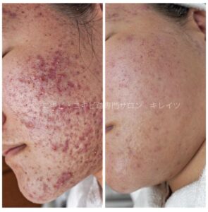 赤ニキビで悩む肌