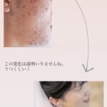 ニキビ肌から、きれいなお肌へ改善した女性