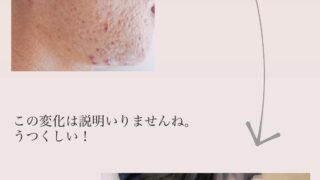 ニキビ肌から、きれいなお肌へ改善した女性